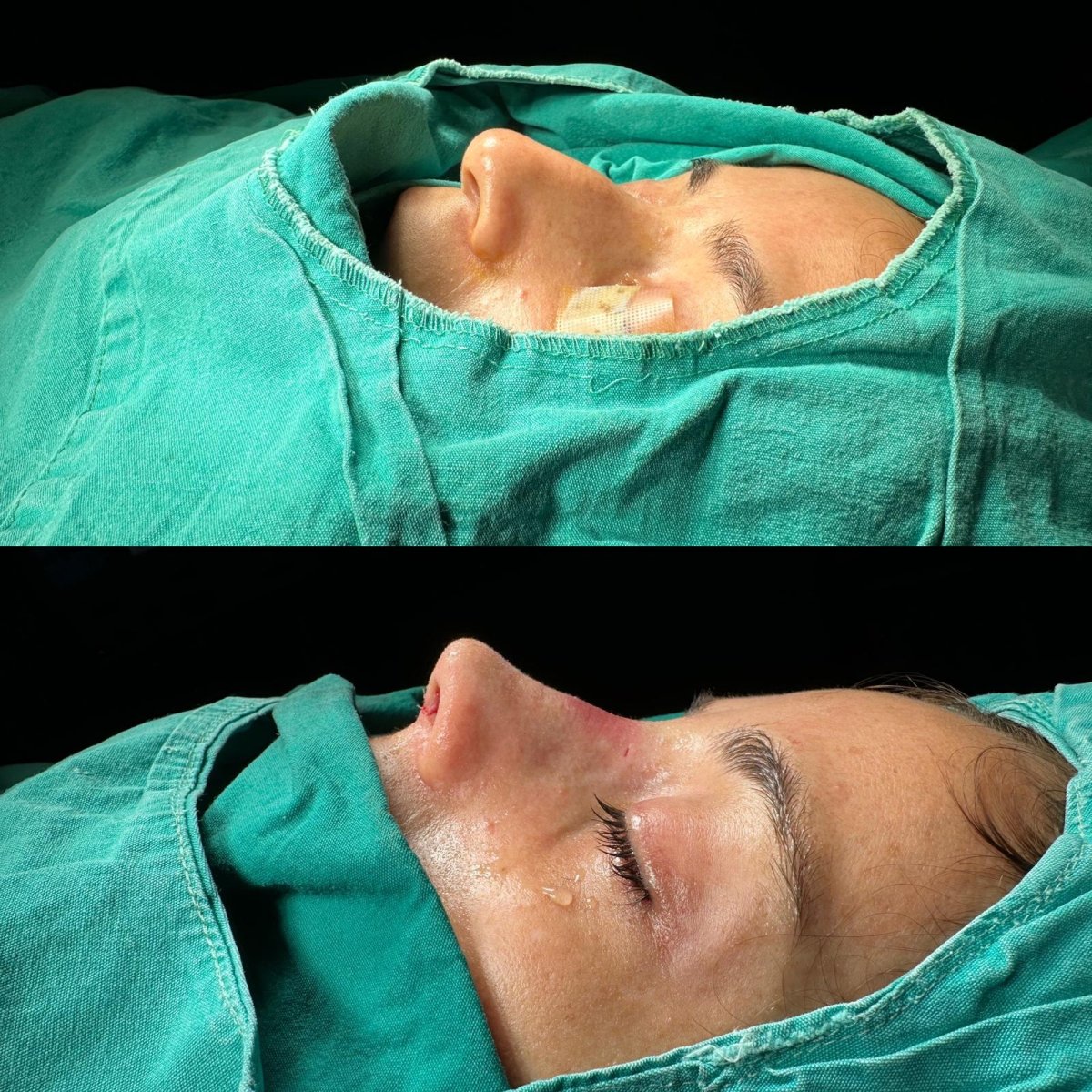 Resultados de rinoplastia antes y después en Optimed International Hospital, perfil nasal mejorado