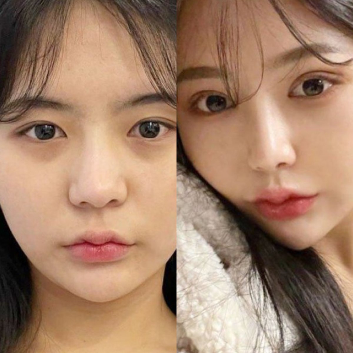 Resultados antes y después de rinoplastia étnica en VG Plastic Surgery, cambio de nariz