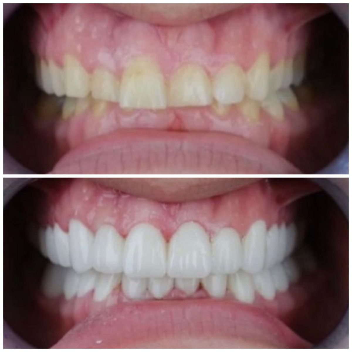 نتائج قبل وبعد تركيب تيجان الزركونيا في TH Dental Clinic – ابتسامة محسنة
