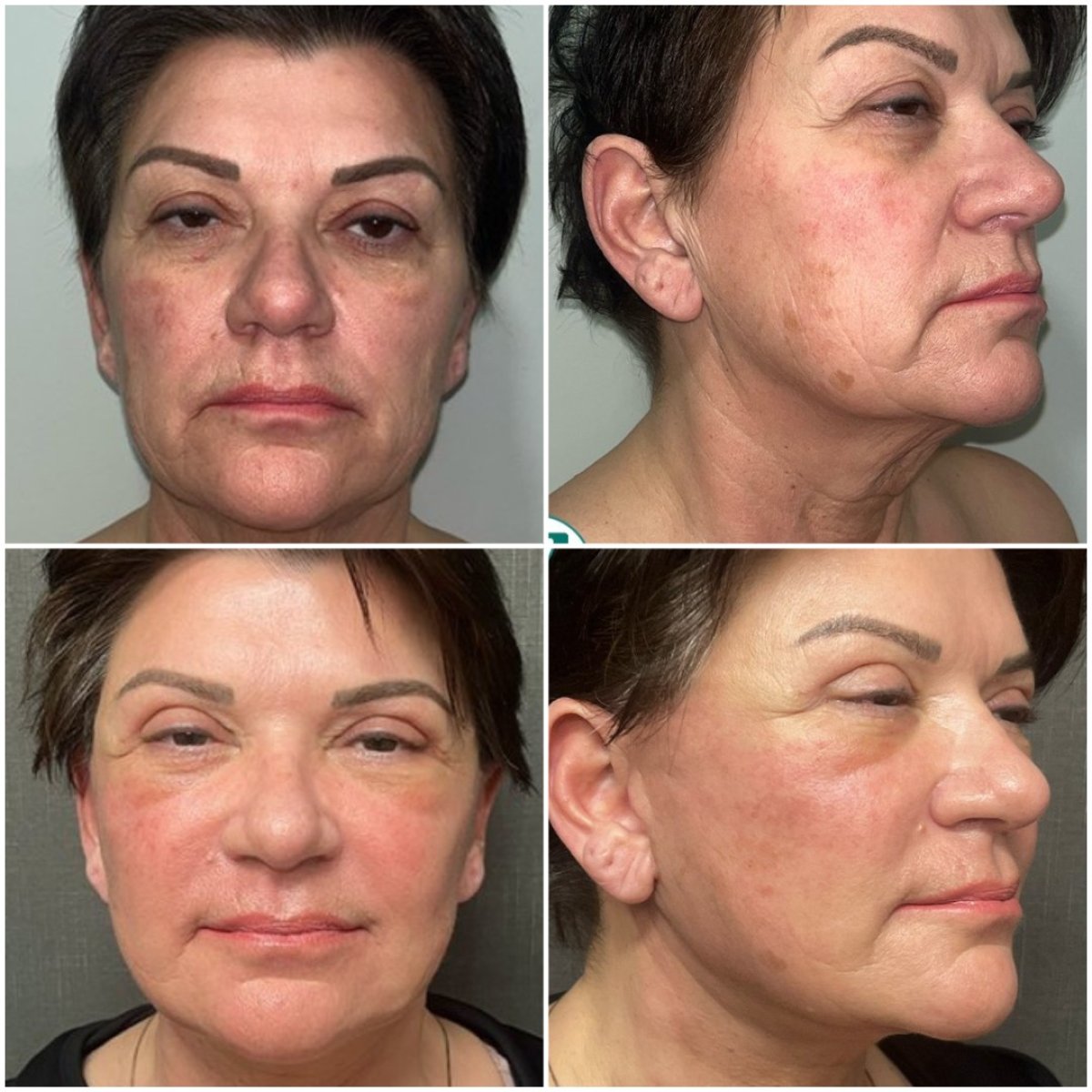 Resultados de lifting facial antes y después en Soraca Med – rejuvenecimiento visible