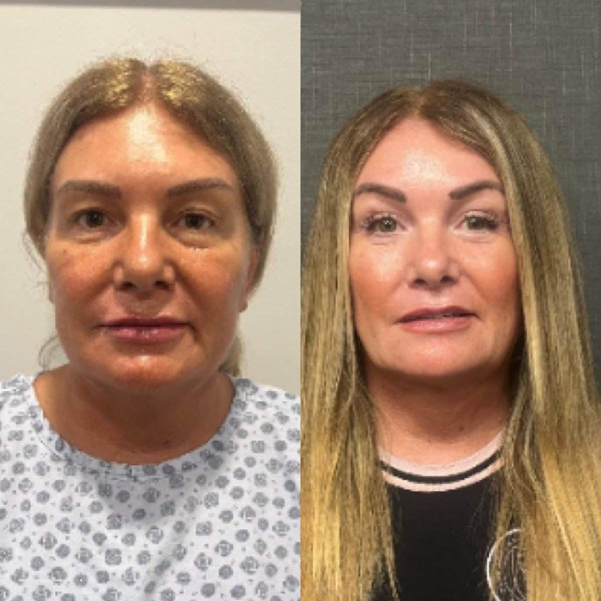 Resultados de lifting facial antes y después en Soraca Med – rejuvenecimiento visible