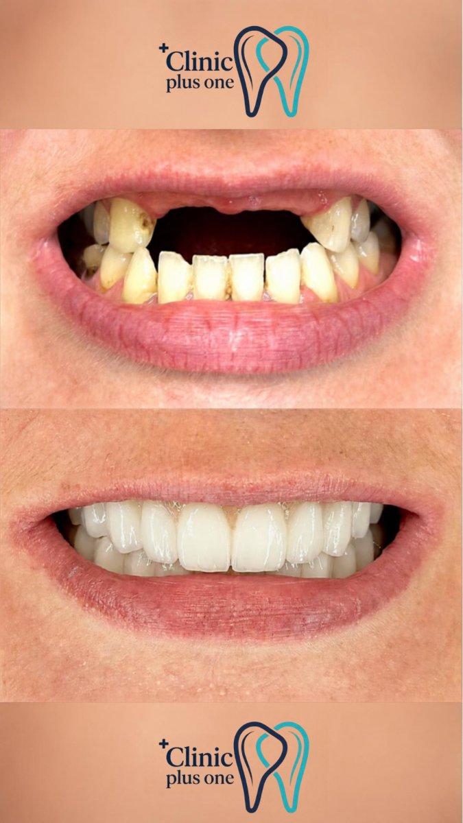 before and after photo