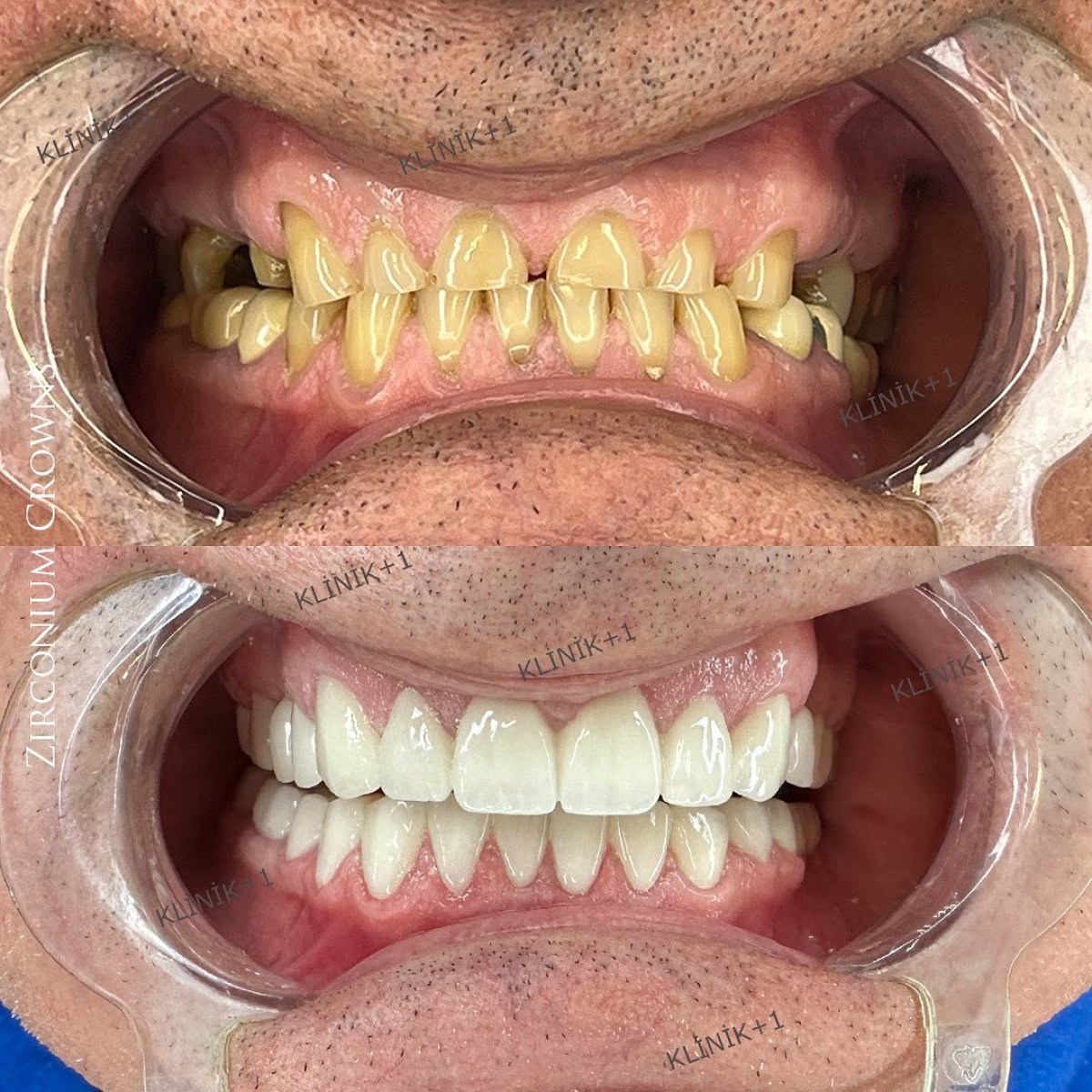 before and after photo