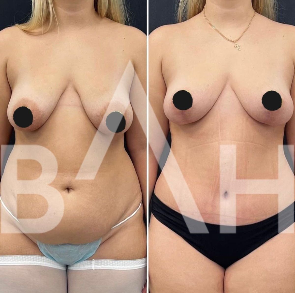 Before and after breast lift results at Büyük Anadolu Hospitals (BAH International), improved contour