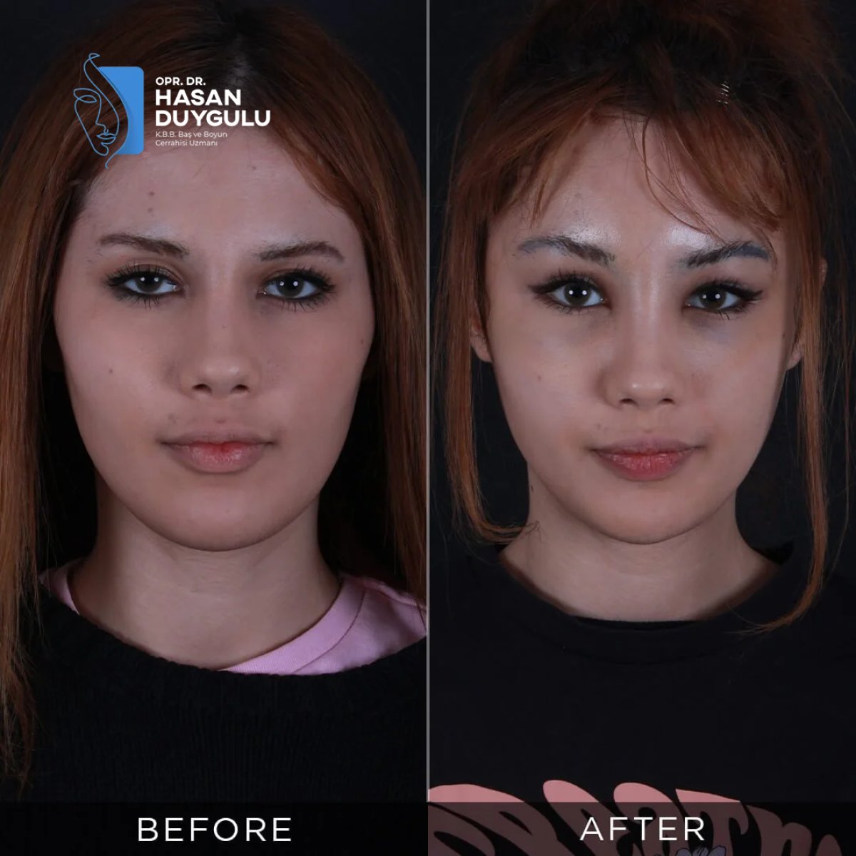 نتائج قبل وبعد Fox Eye Lift في عيادة Dr. Hasan Duygulu - Face Aesthetics Turkey