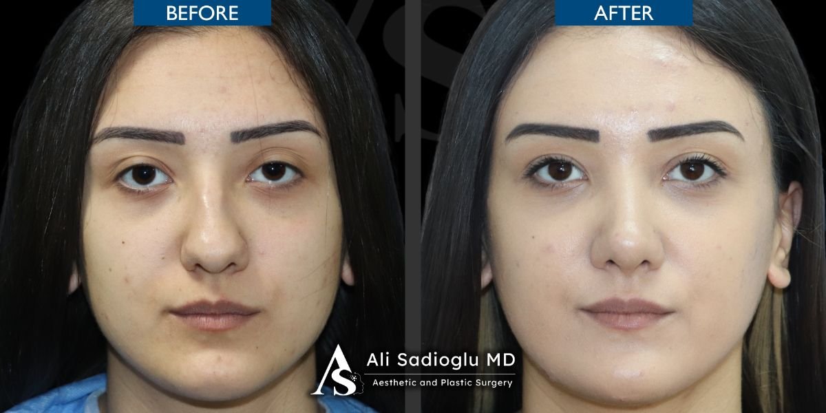 نتائج تجميل الأنف قبل وبعد في عيادة Dr. Safa Manav، إعادة تشكيل الأنف للنساء
