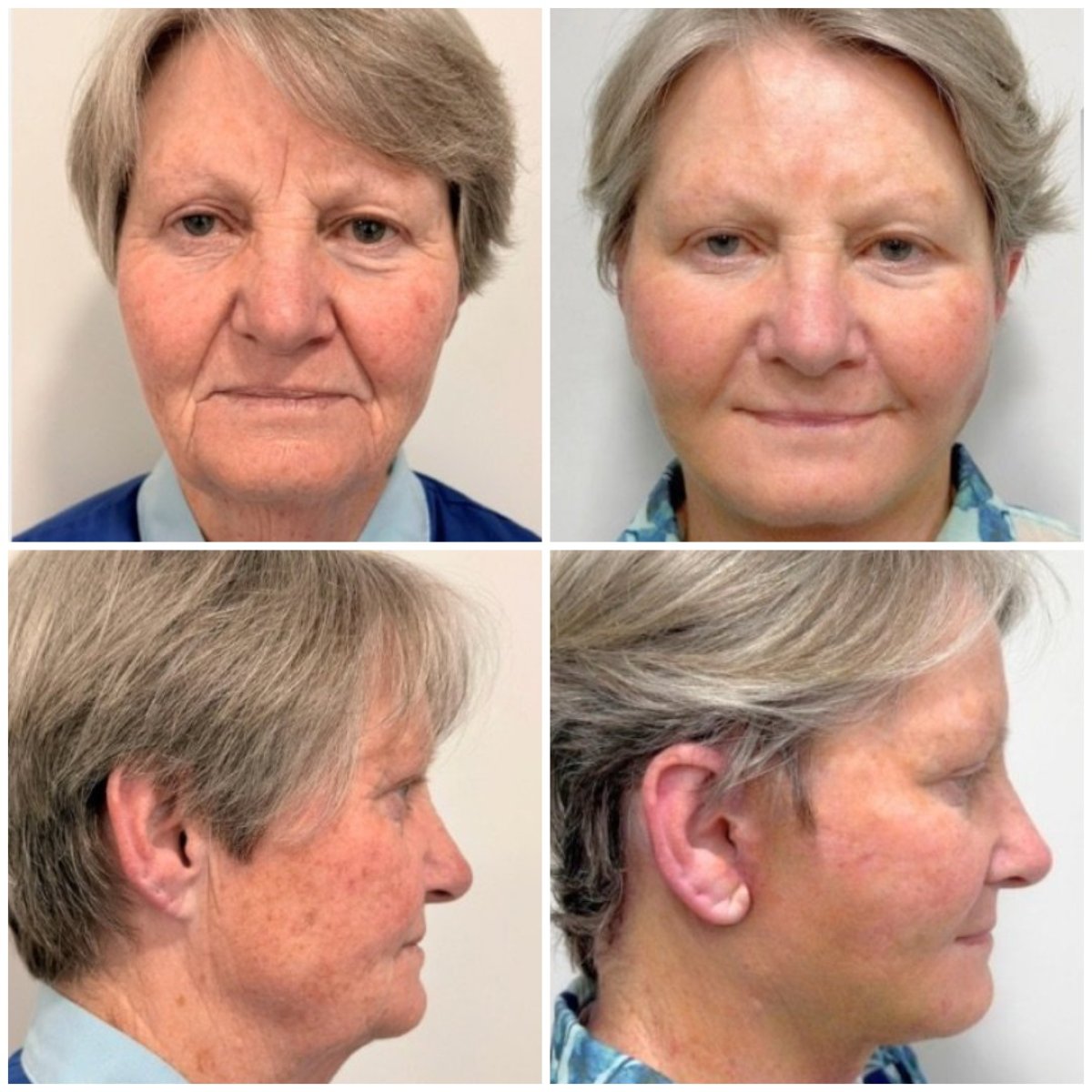 Resultados de minilifting facial antes y después en ID Clinic Bangkok, rejuvenecimiento visible