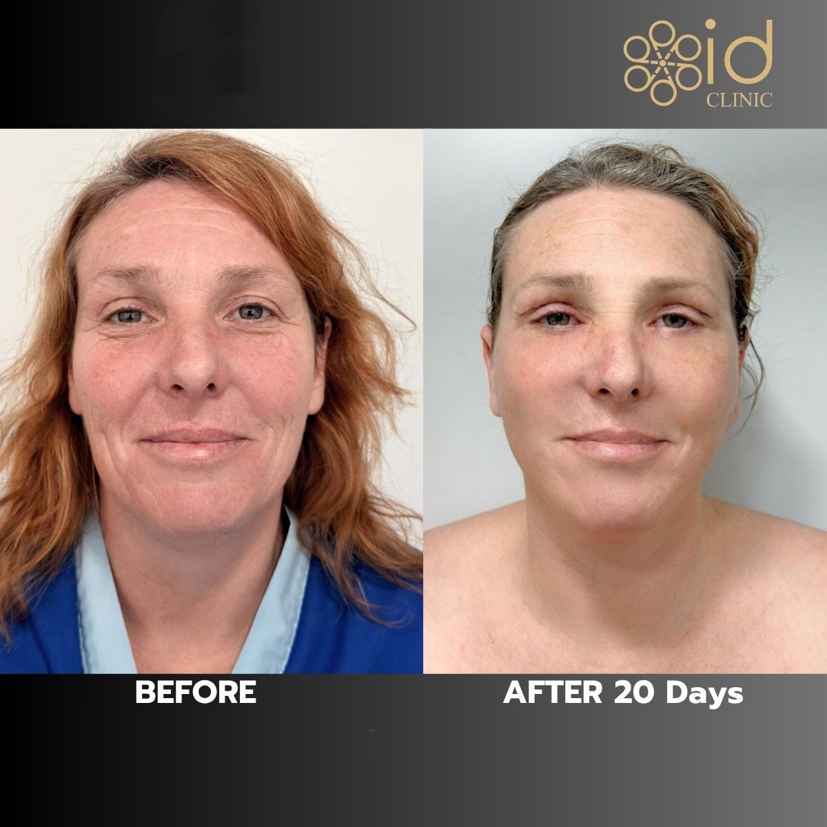Resultados de minilifting facial en ID Clinic Bangkok, rejuvenecimiento visible tras 20 días
