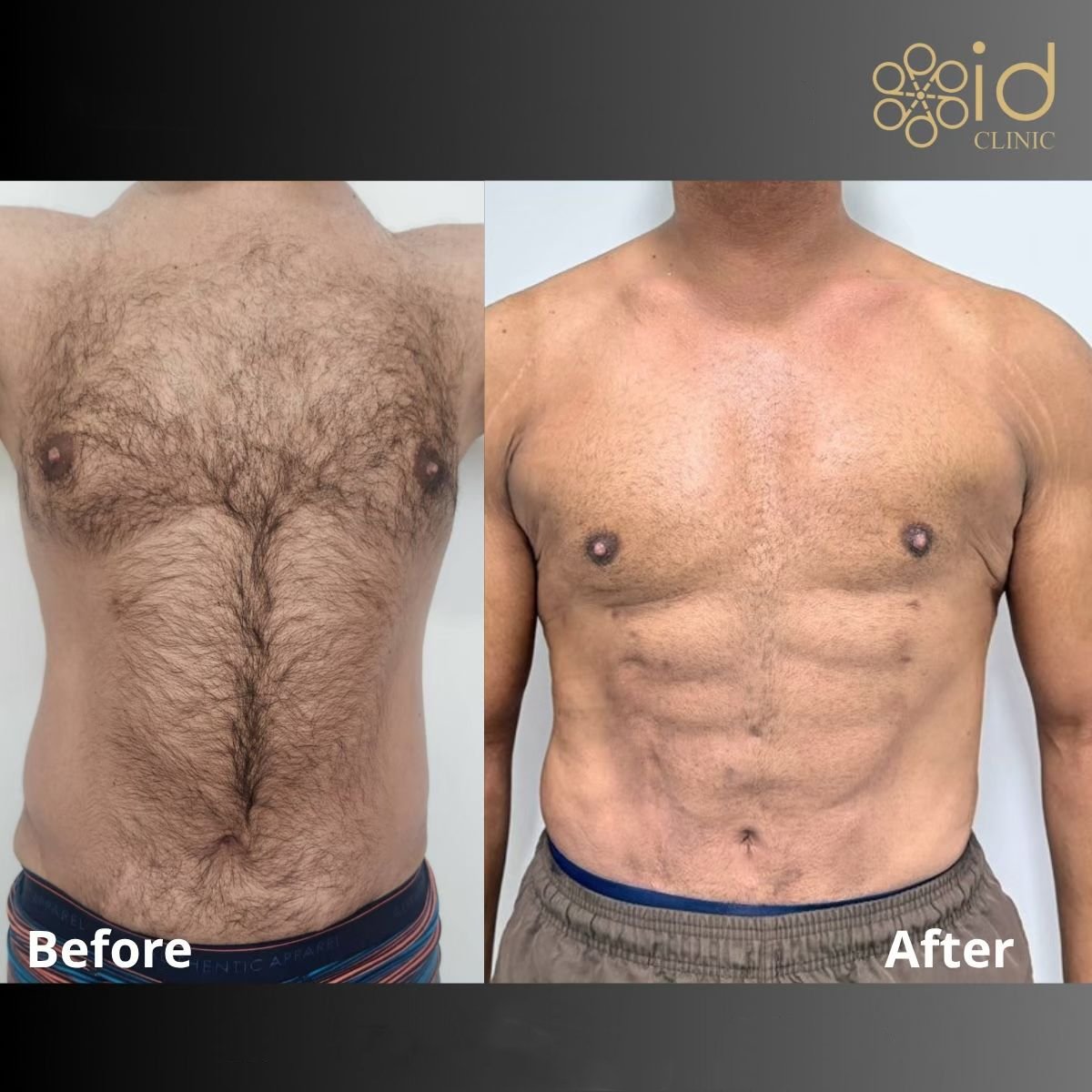 نتائج نحت البطن (عضلات البطن الستة) قبل وبعد في ID Clinic Bangkok