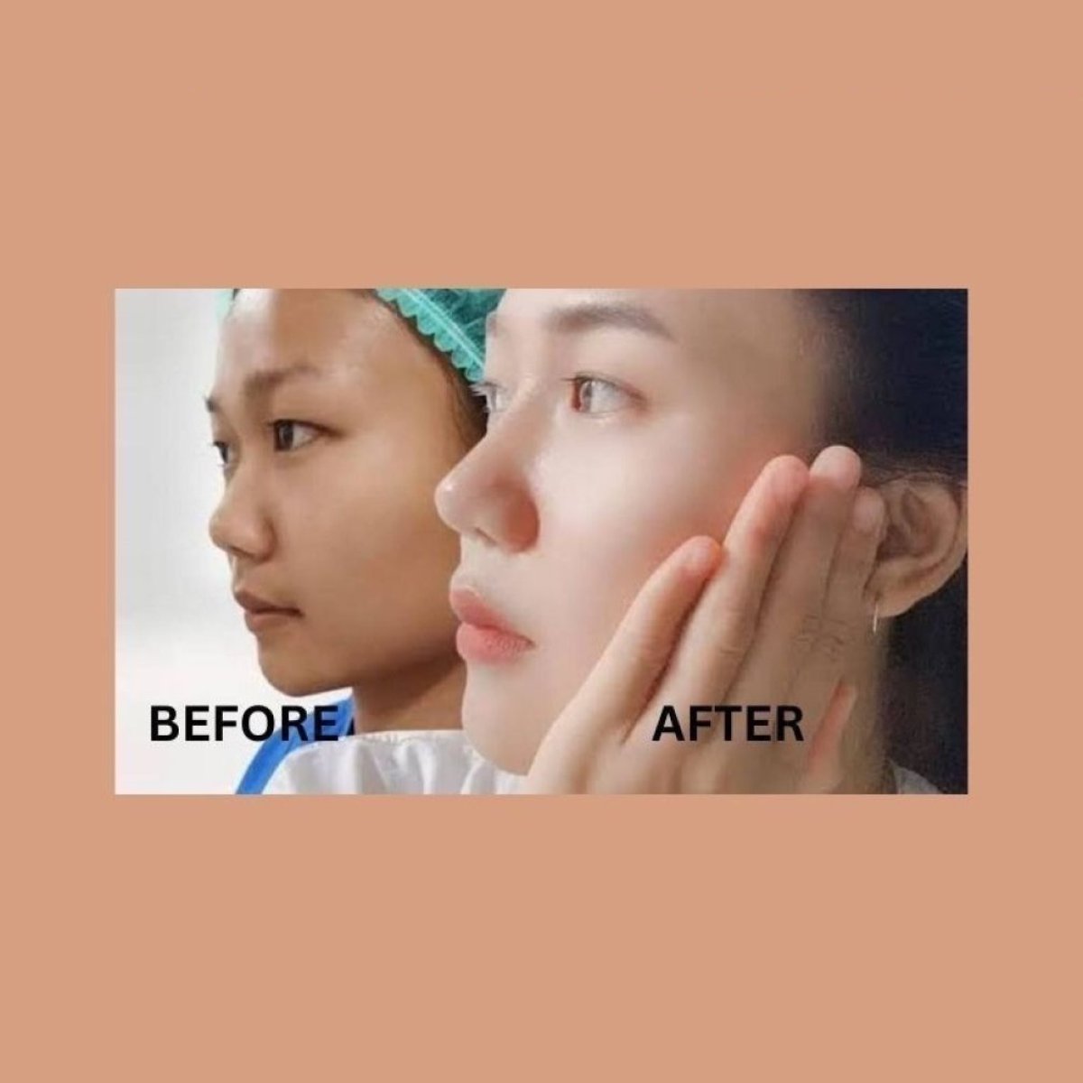 Resultados de rinoplastia étnica antes y después en ID Clinic Bangkok, perfil nasal mejorado