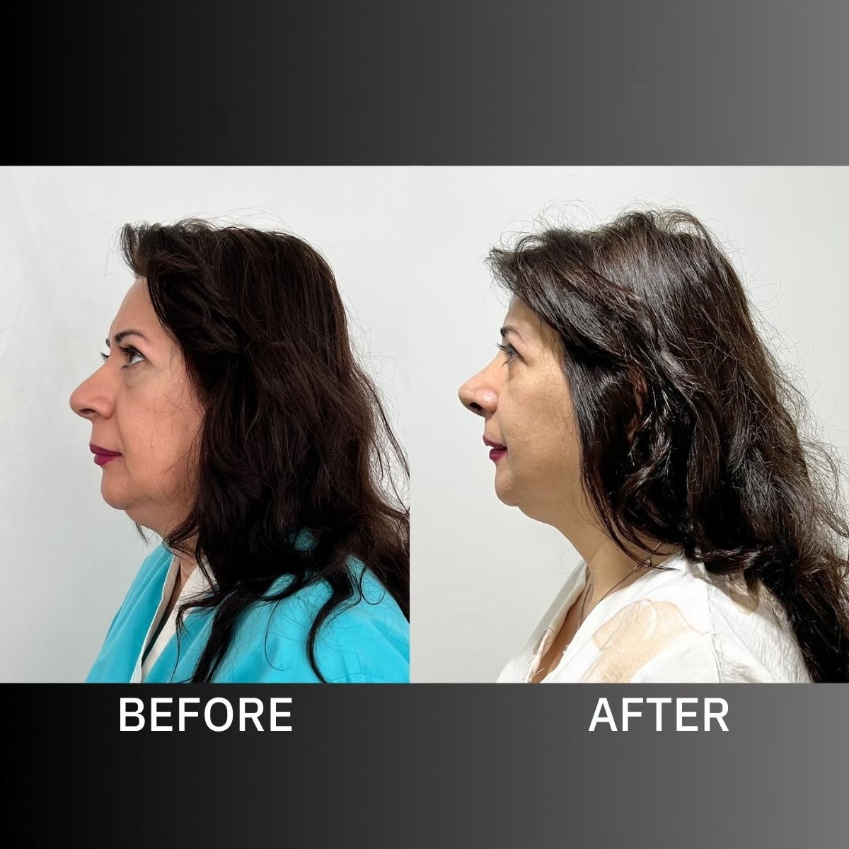 Resultados de rinoplastia étnica antes y después en ID Clinic Bangkok, perfil nasal mejorado