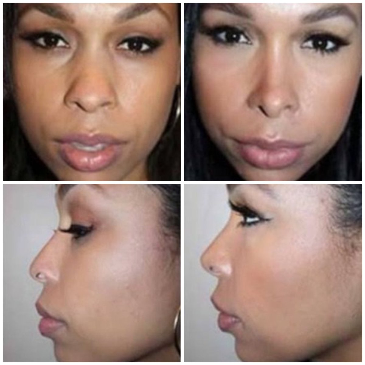 Resultados de rinoplastia étnica antes y después en ID Clinic Bangkok, mejora de la nariz