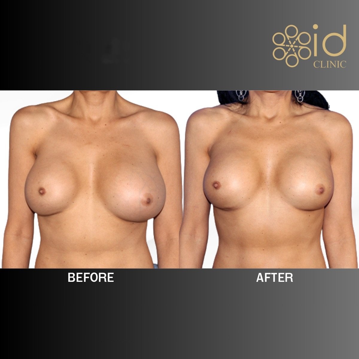 Before and after breast implant revision results at ID Clinic Bangkok, improved breast shape