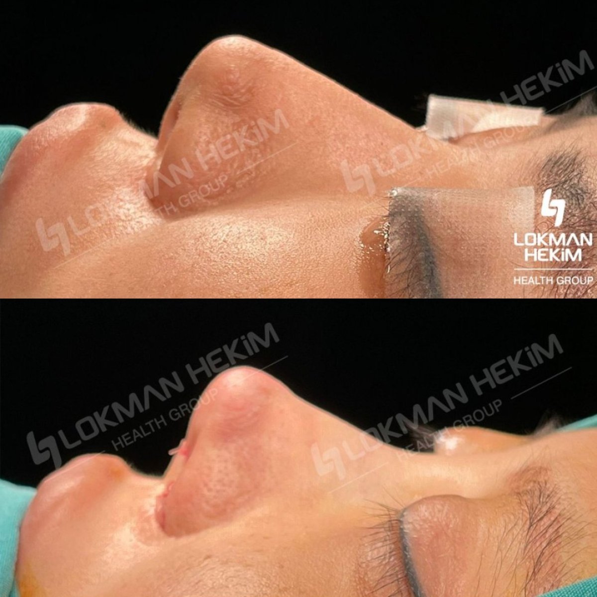 Resultados antes y después de rinoplastia ultrasónica en Lokman Hekim Istanbul Hospital, remodelación nasal
