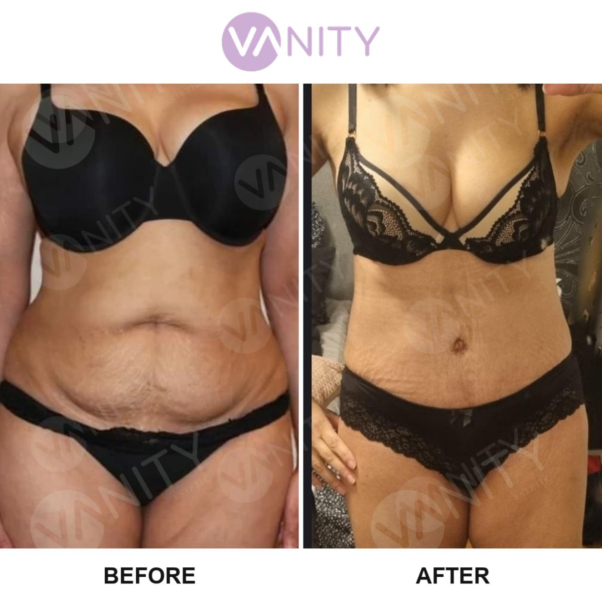 Результаты до и после абдоминопластики в Vanity Cosmetic Surgery Center, плоский живот