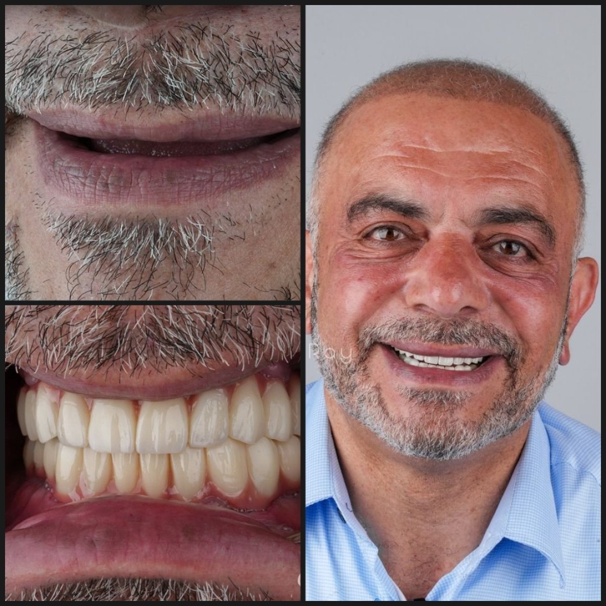 Resultados antes y después de implante dental con corona en Dentaray Clinic, sonrisa restaurada