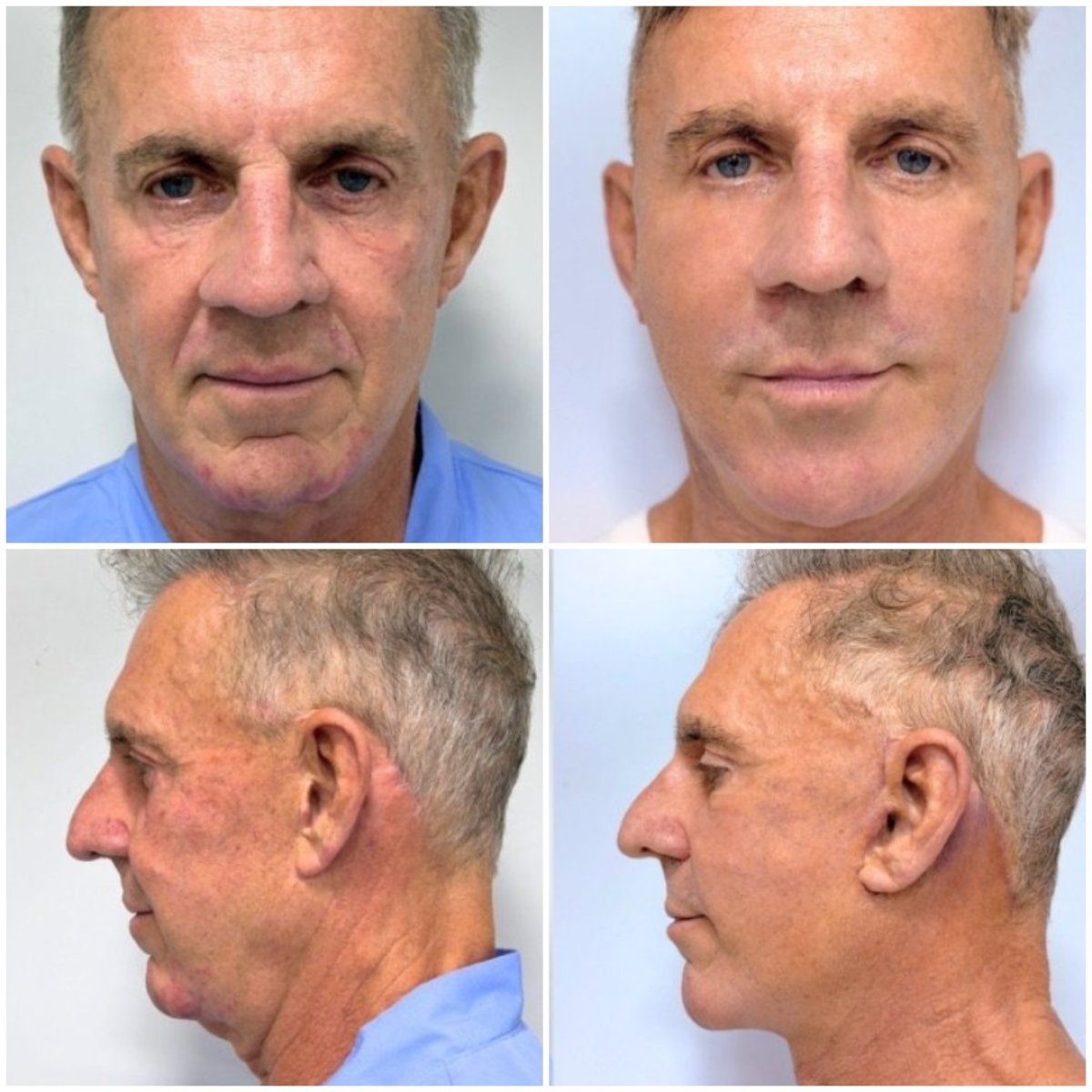 Resultados de lifting facial antes y después en ID Clinic Bangkok, rejuvenecimiento visible