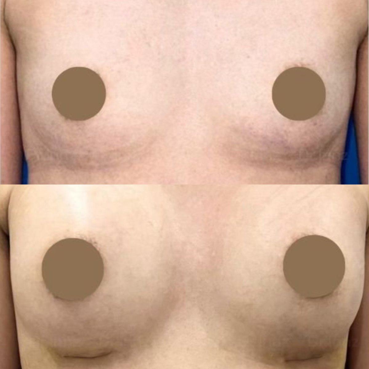 Before and after breast augmentation results at Intrarat Hospital, enhanced breast volume
