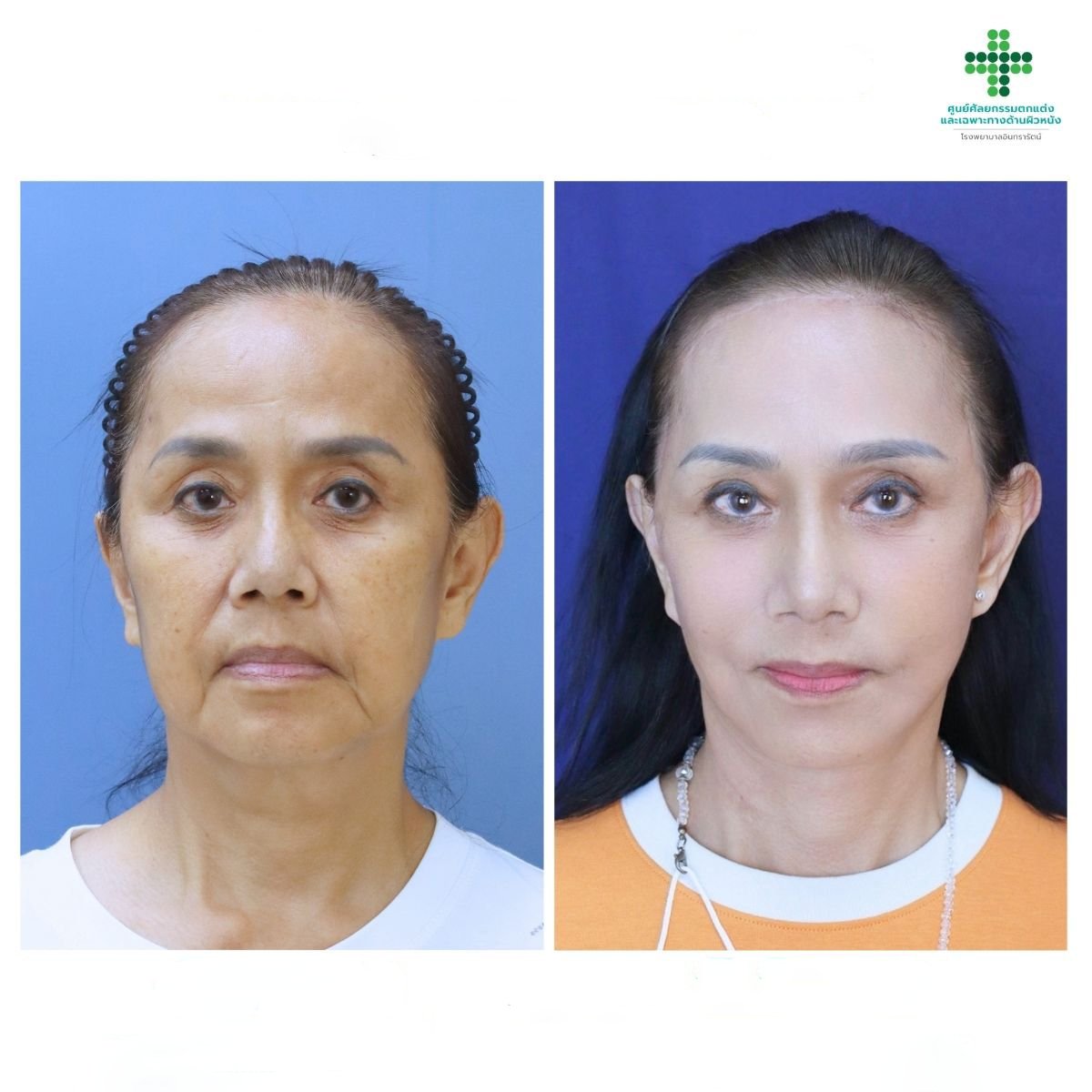 Resultados de lifting facial antes y después en Intrarat Hospital – rejuvenecimiento visible