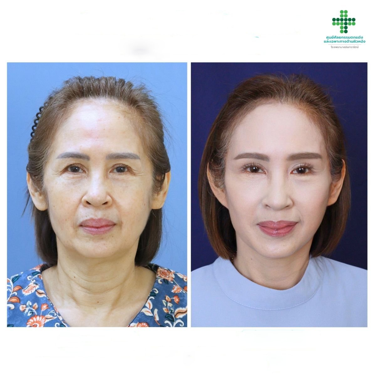 Resultados de lifting facial antes y después en Intrarat Hospital, rejuvenecimiento facial