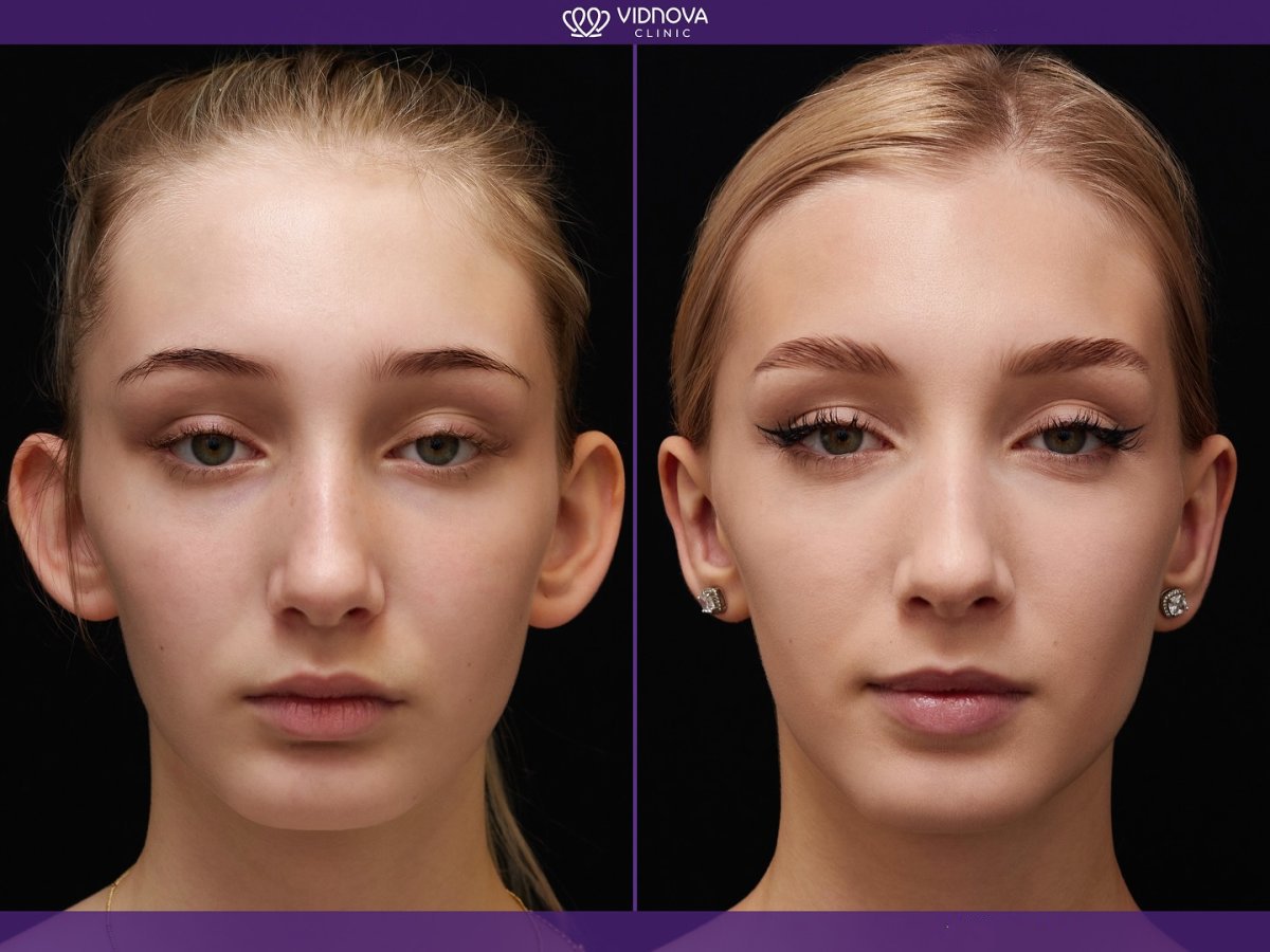 Resultados de otoplastia antes y después en Vidnova Clinic: mejora de forma y simetría de orejas