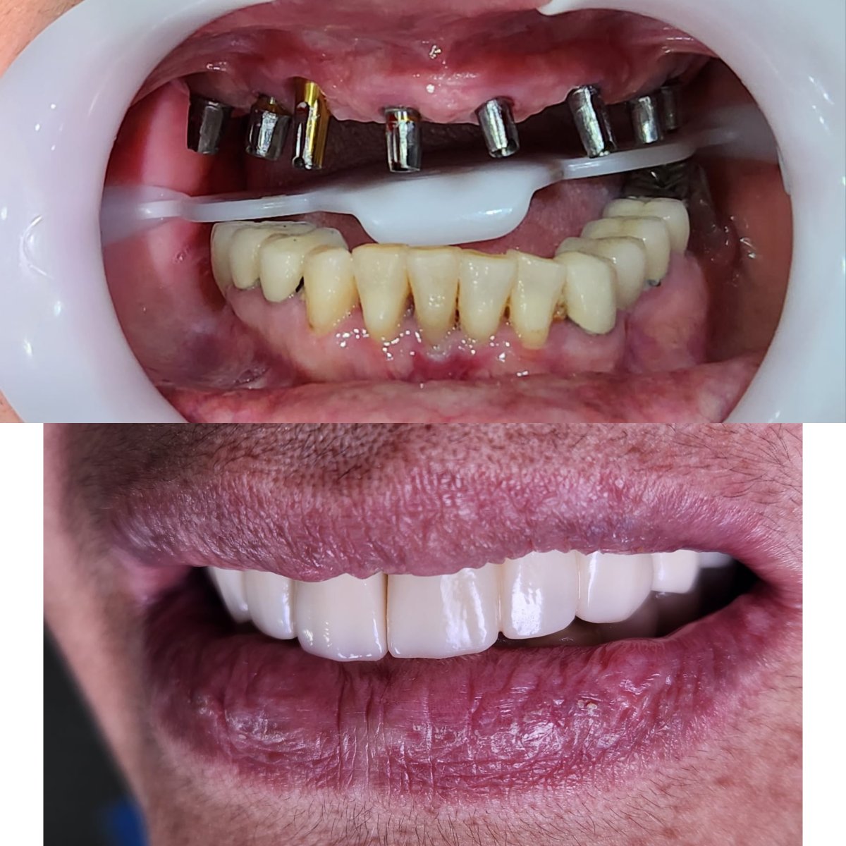 Before and after dental implant results – restored upper teeth and improved smile