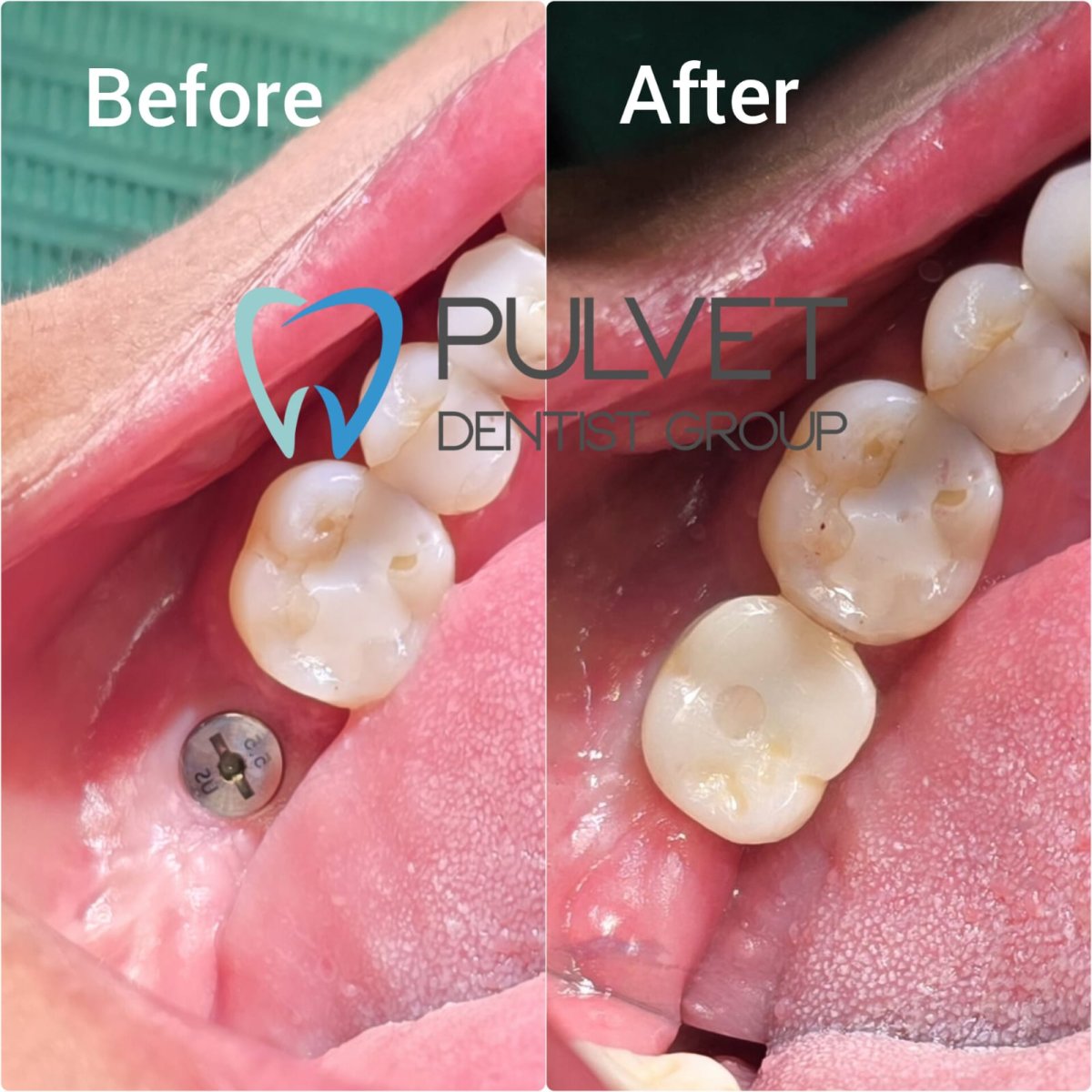 Before and after dental implant with crown result at Pulvet Dentist Group, restored molar