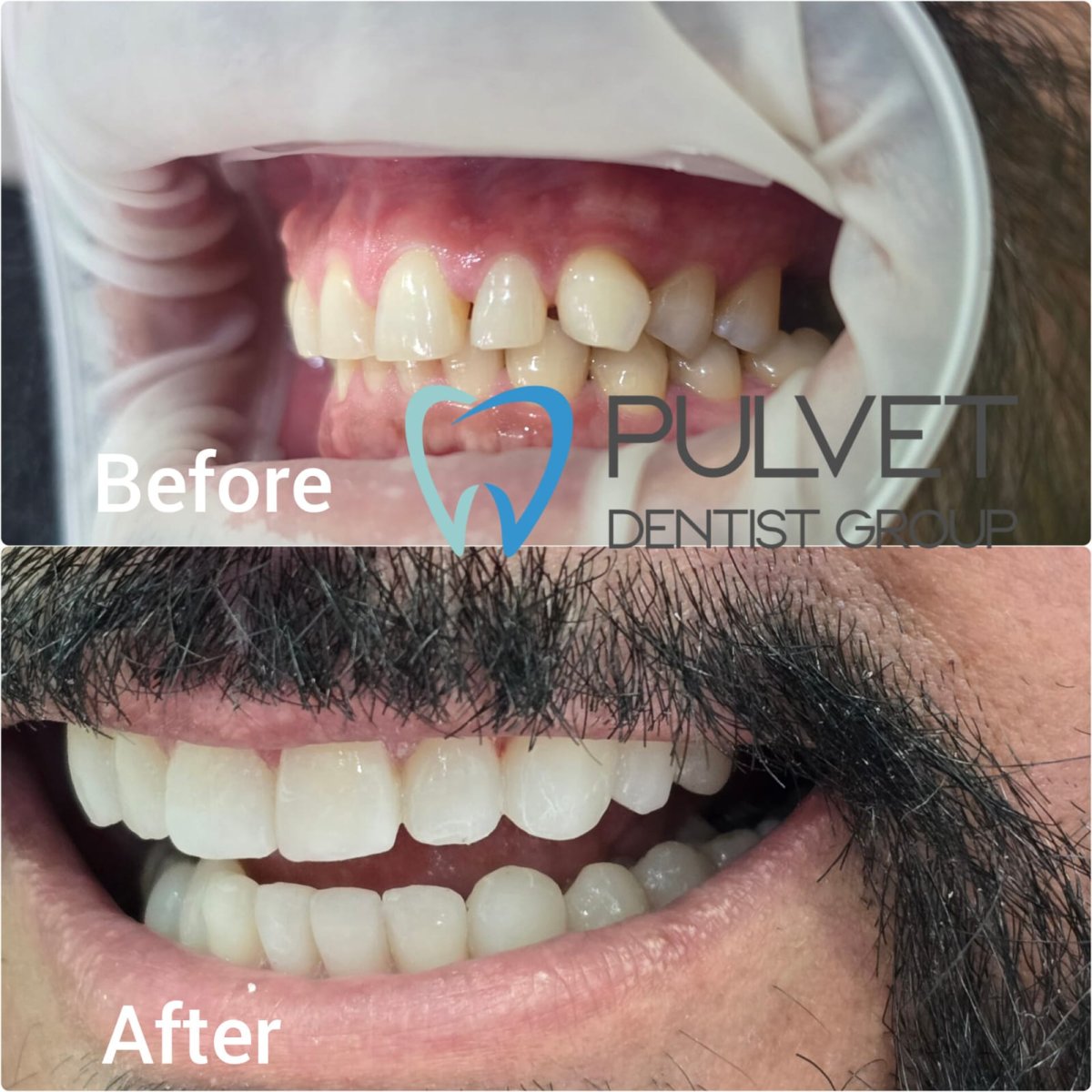 Efekty Hollywood Smile przed i po w Pulvet Dentist Group – metamorfoza licówkami