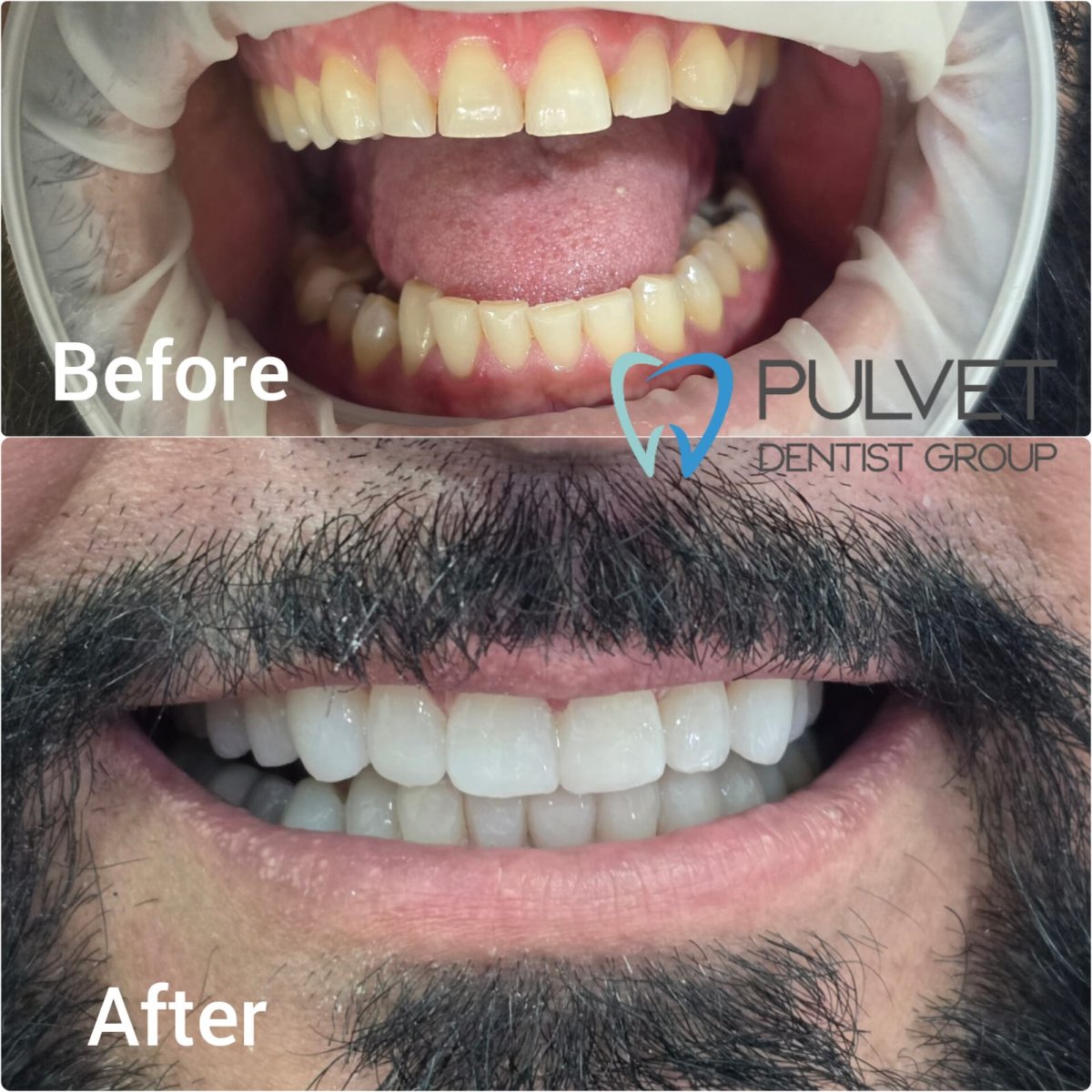 Efekty Hollywood Smile przed i po w Pulvet Dentist Group – widoczna metamorfoza uśmiechu