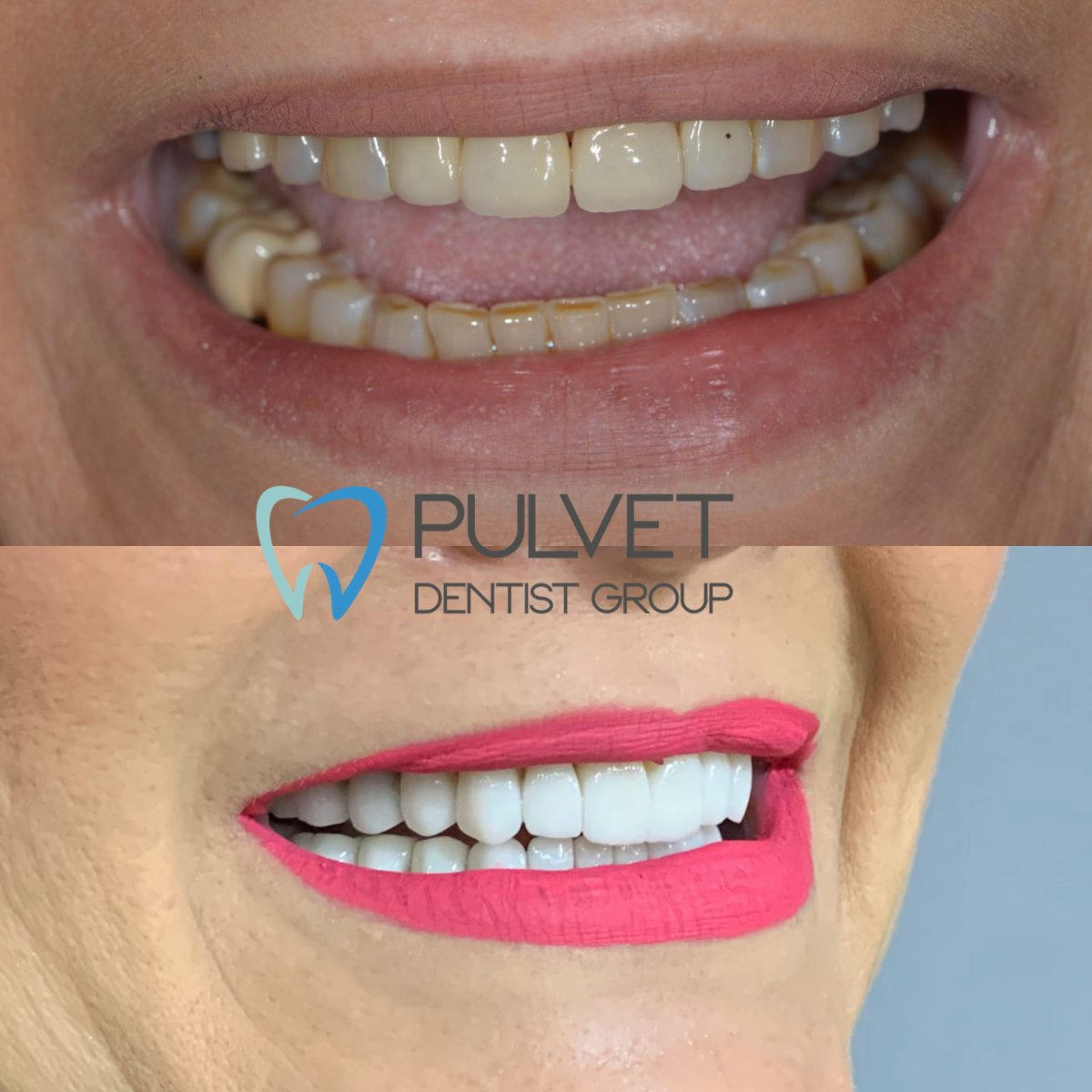 Resultados de Hollywood Smile antes y después en Pulvet Dentist Group – dientes blancos y parejos
