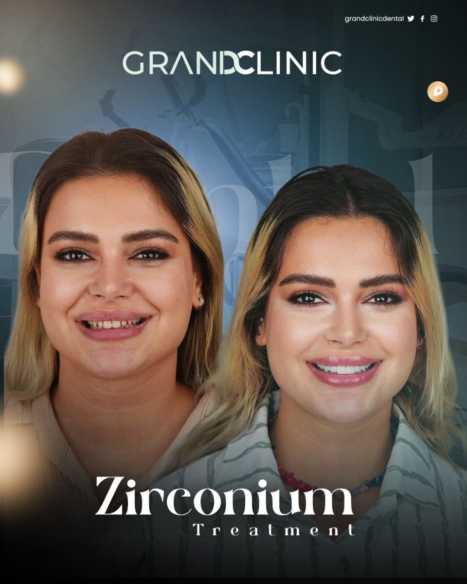 До и после установки циркониевого моста в Grand Clinic – улучшенная улыбка