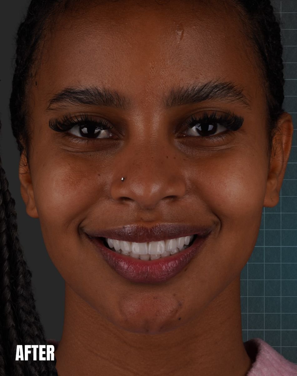 Dental implant after result at Esnan Dental Clinics – restored smile with natural teeth look