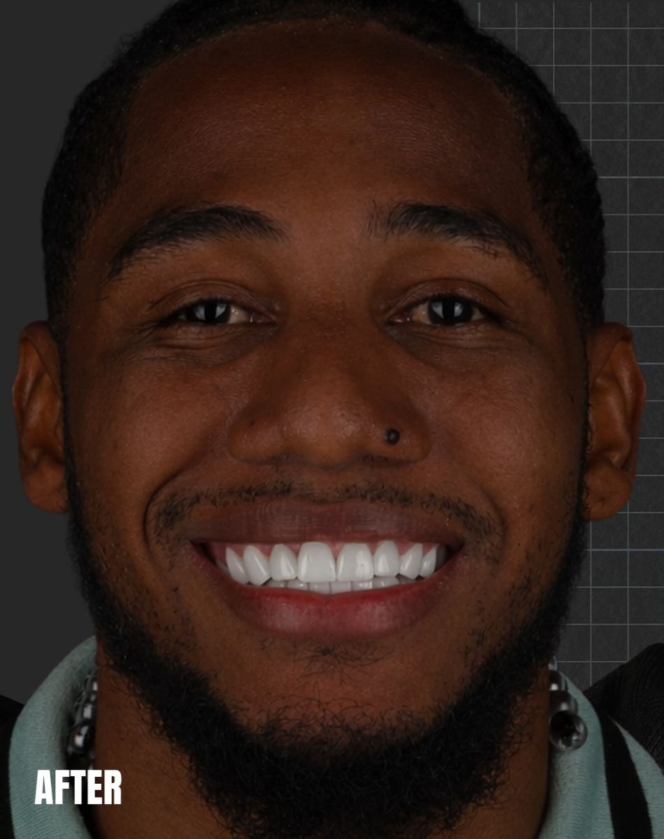 Resultado de implante dental en Esnan Dental Clinics: sonrisa mejorada con dientes naturales