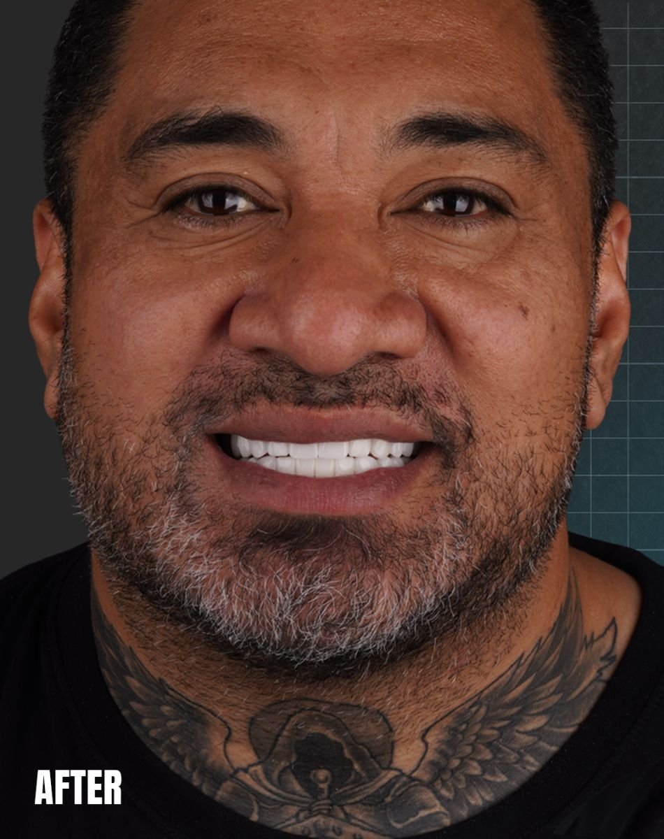 Resultado de implante dental en Esnan Dental Clinics: sonrisa mejorada con dientes naturales