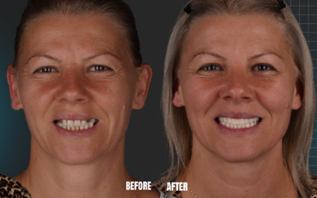 Resultados antes y después de implantes dentales All-on-6 en Esnan Dental Clinics, sonrisa restaurada