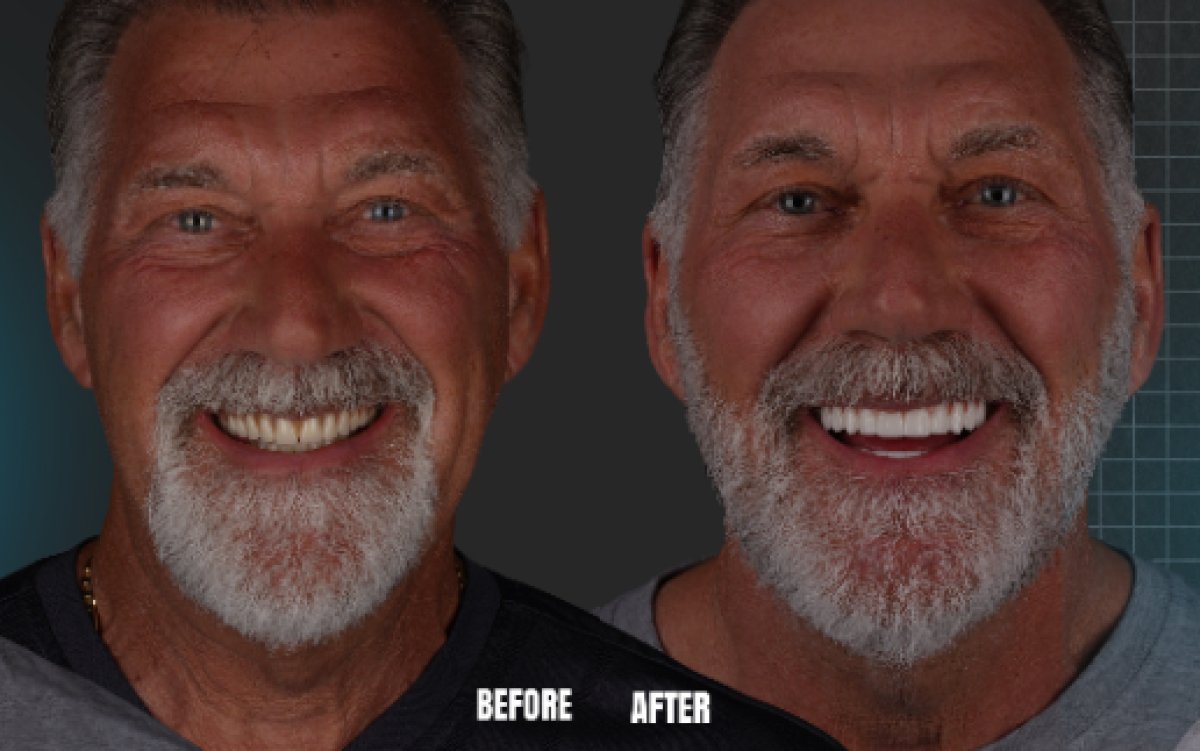 Resultado antes y después de implantes dentales All-on-6 en Esnan Dental Clinics, sonrisa mejorada