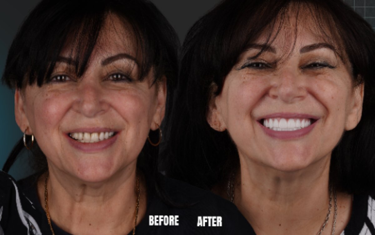 Resultado antes y después de implantes All-on-6 en Esnan Dental Clinics, restauración de sonrisa
