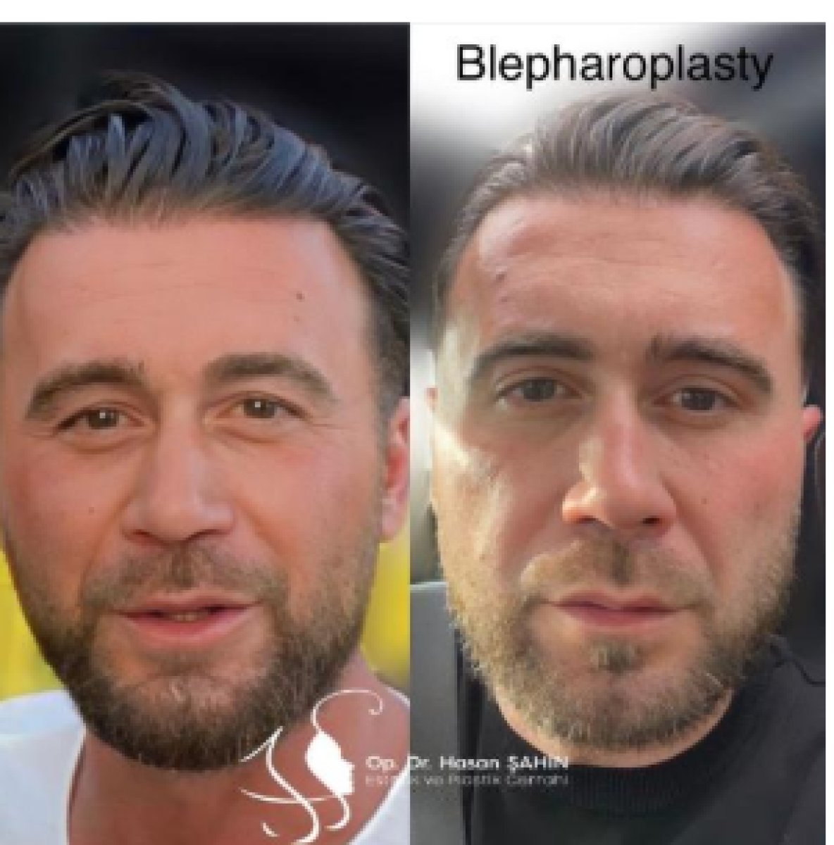 Resultados de blefaroplastia antes y después en Hisar Hospital Intercontinental, corrección de párpados