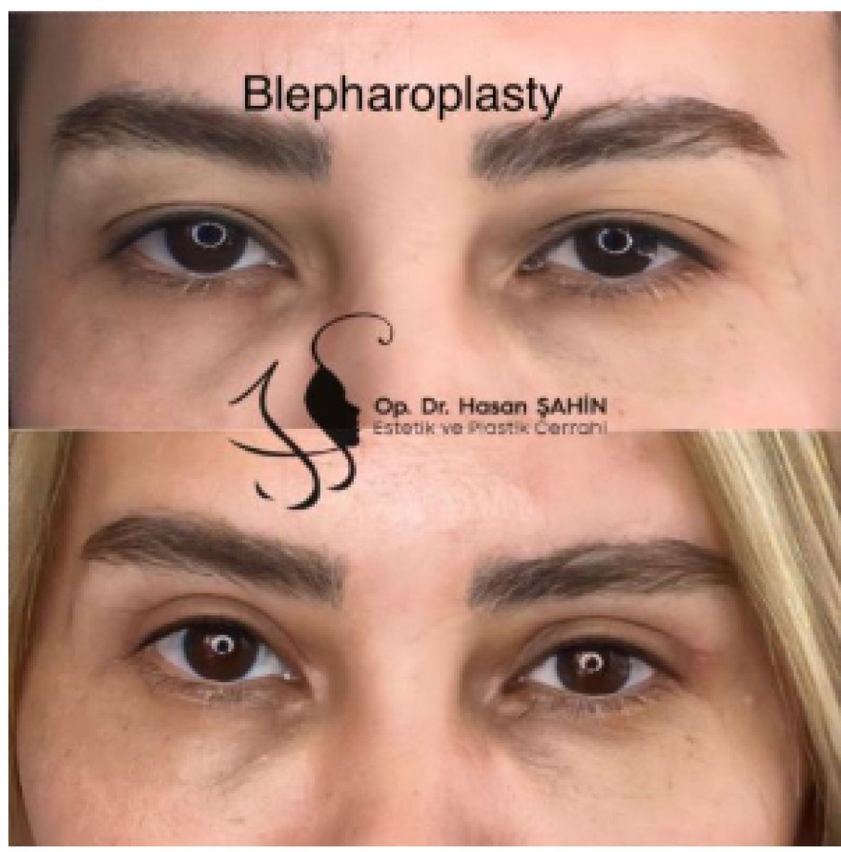 Resultados de blefaroplastia antes y después en Hisar Hospital Intercontinental, corrección de párpados
