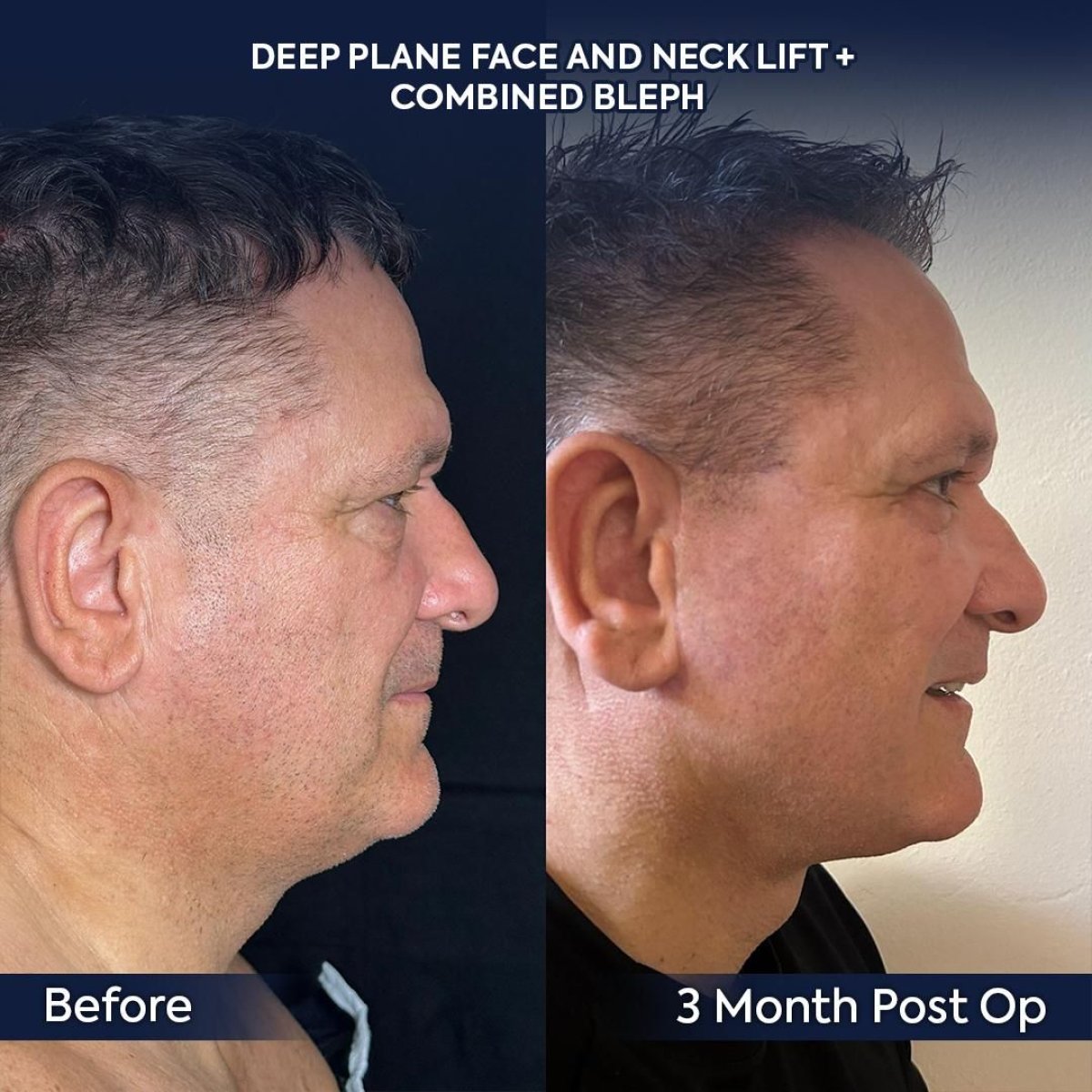 Результаты до и после глубокого SMAS-лифтинга и подтяжки шеи в клинике Dr. Safa Manav