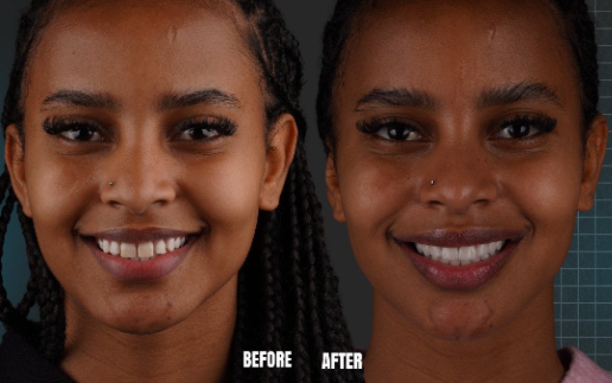Resultado antes y después de carillas dentales en Esnan Dental Clinics, sonrisa mejorada