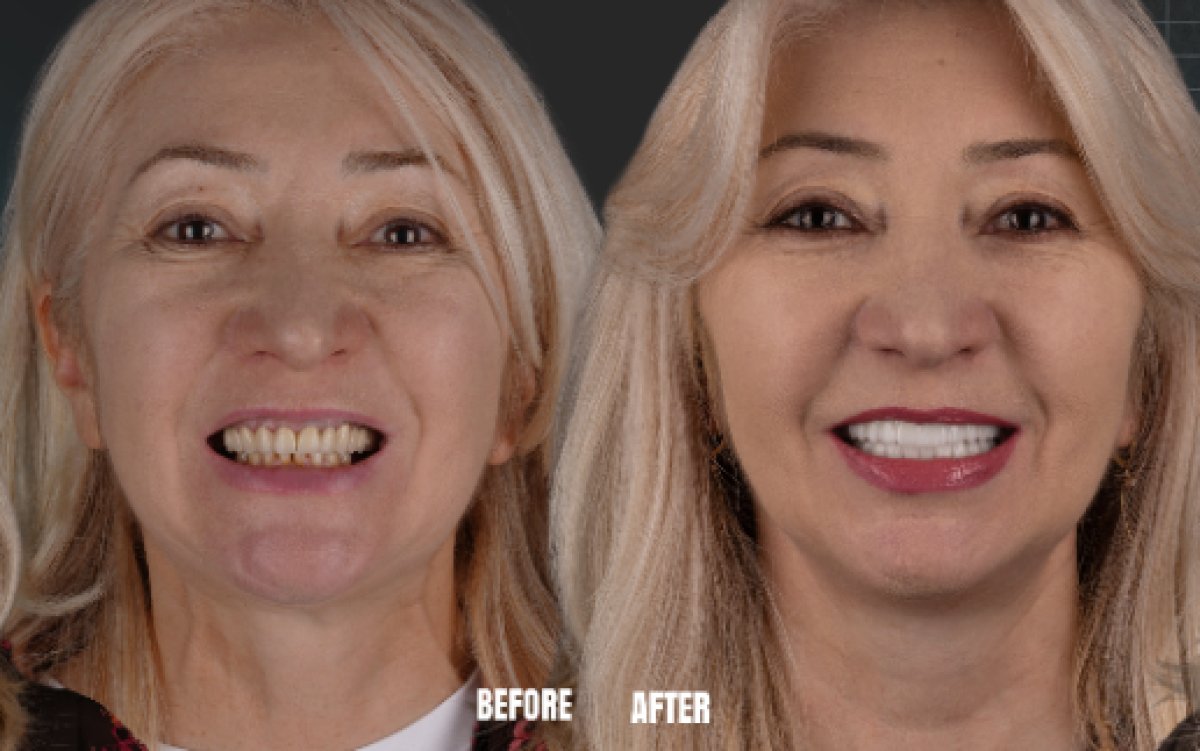 Resultados antes y después de implantes dentales All-on-4 en Esnan Dental Clinics, sonrisa mejorada