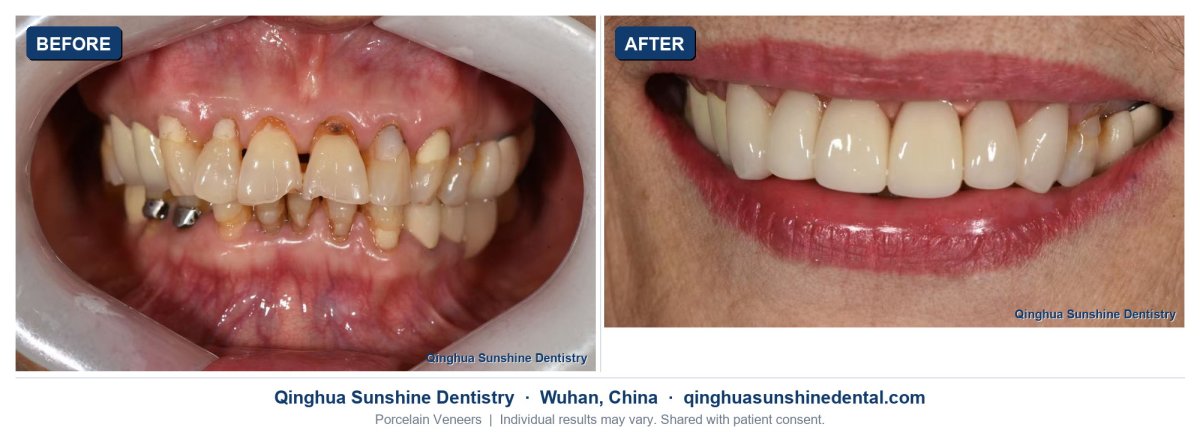نتيجة قبل وبعد عدسات الفينير الخزفية في عيادة Qinghua Sunshine Dentistry (ووهان)