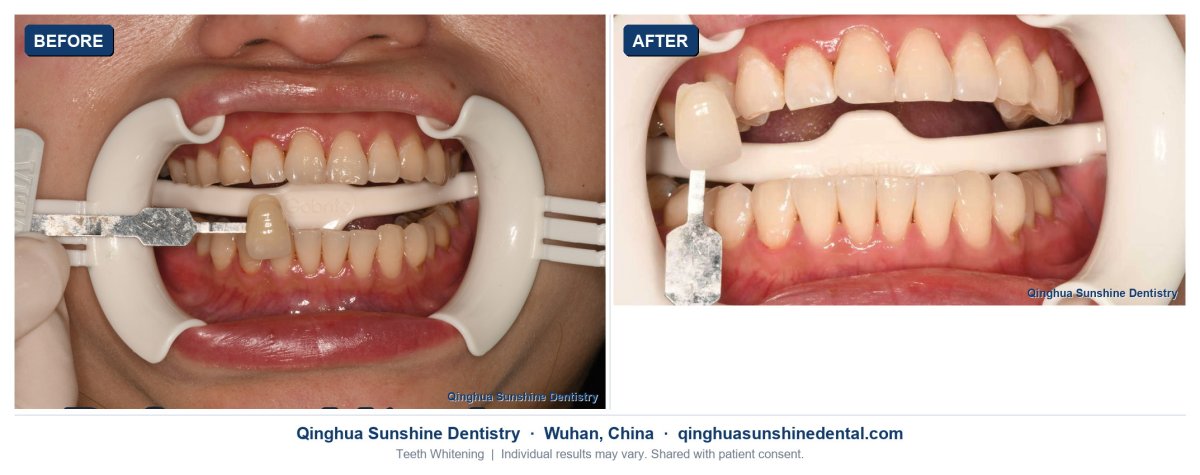 before and after photo