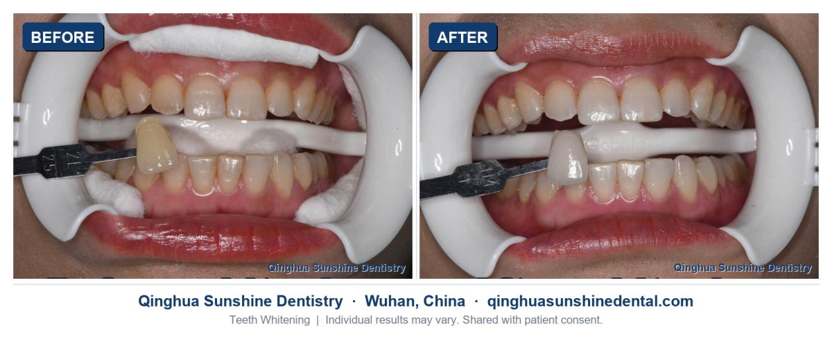 before and after photo