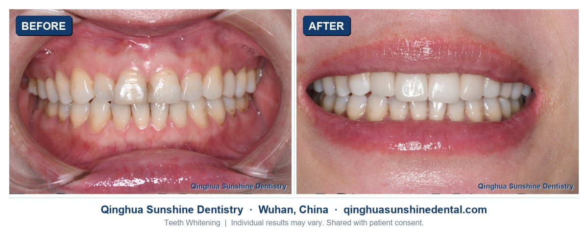 before and after photo