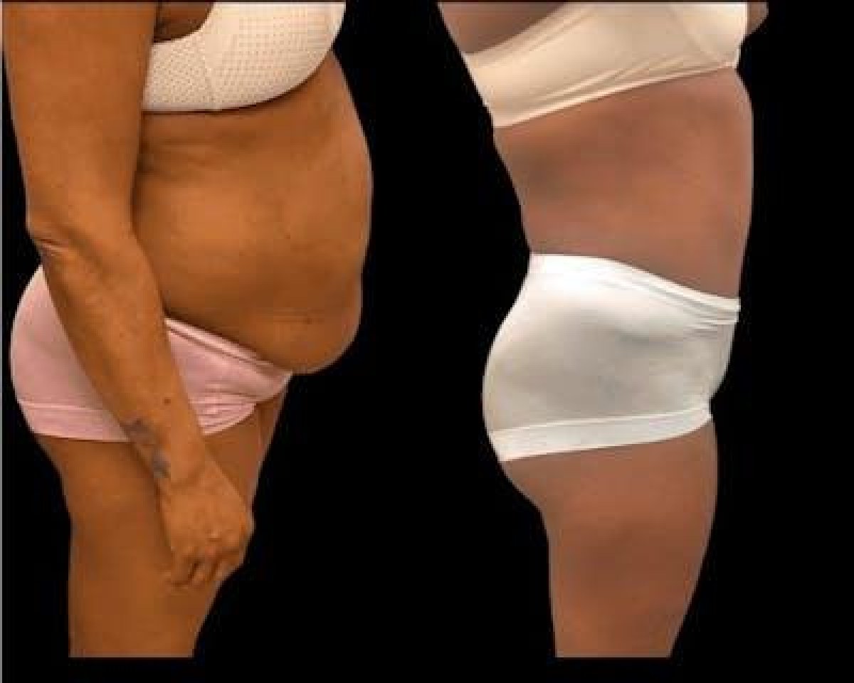 Resultados antes y después de mommy makeover en Hisar Hospital Intercontinental, contorno corporal