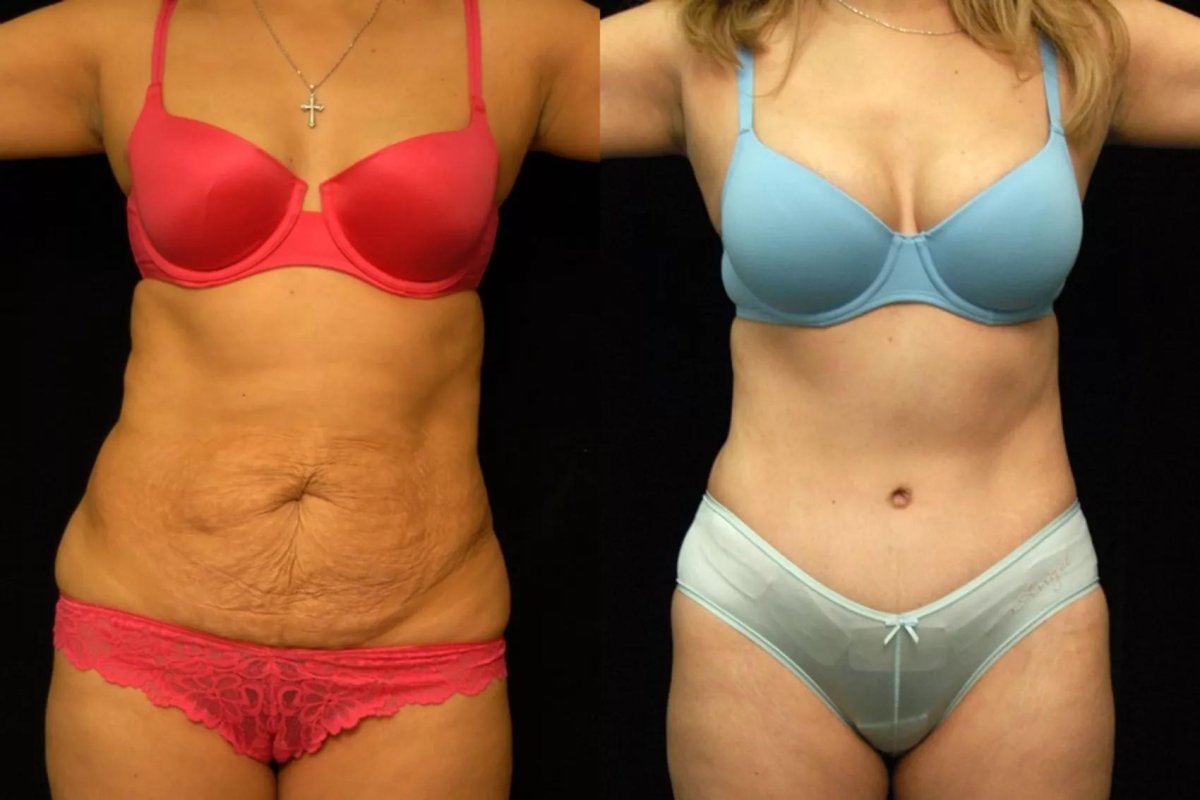 Mommy makeover before and after results at Hisar Hospital Intercontinental – body contouring