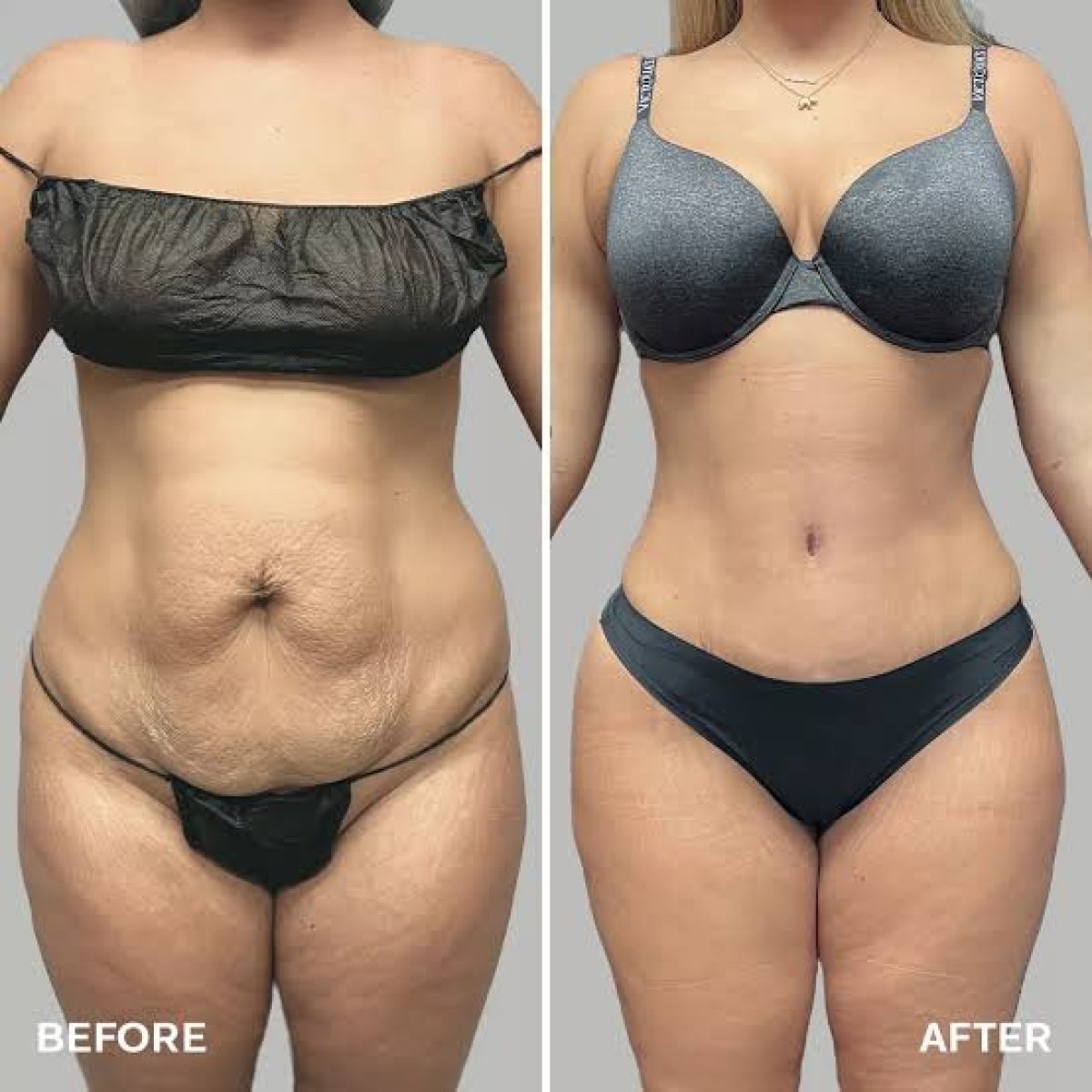 Resultados antes y después de mommy makeover en Hisar Hospital Intercontinental, contorno corporal