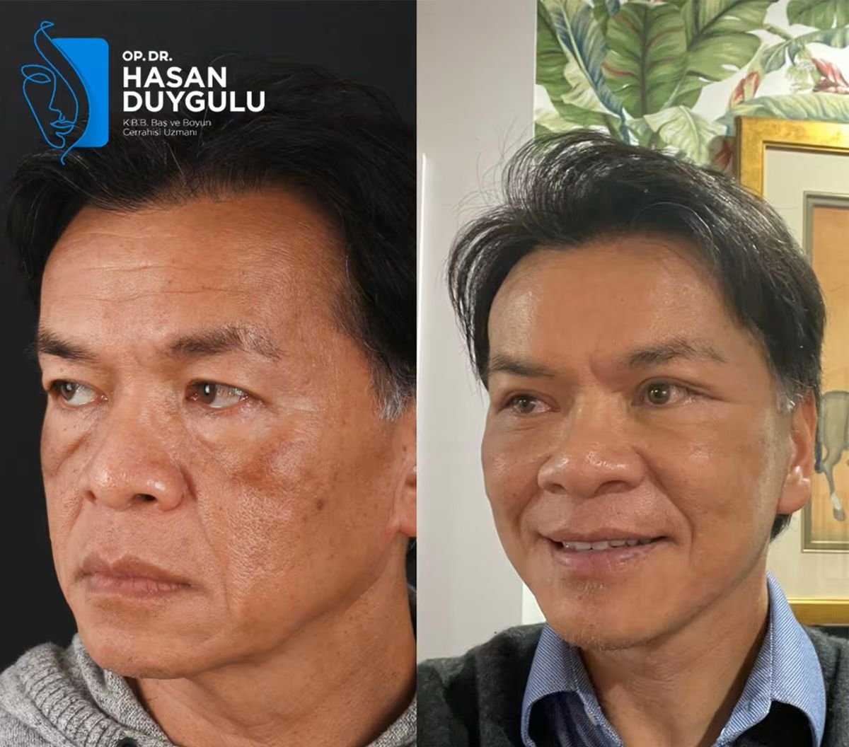 Facelift before and after results at Dr. Hasan Duygulu - Face Aesthetics Clinic Turkey